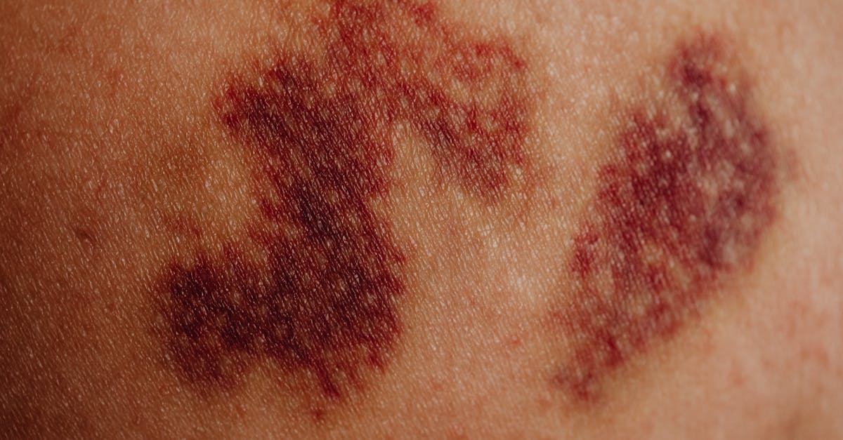 découvrez tout sur les caillots sanguins : causes, symptômes, traitements et conseils pour prévenir les risques. informez-vous sur l'importance de la circulation sanguine pour votre santé.