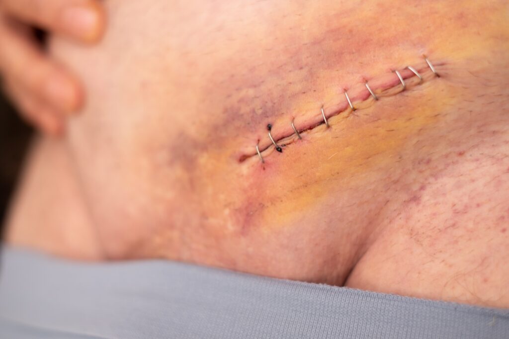Nine staples to the groin scar on the body of elderly gentleman after an inguinal hernia operation