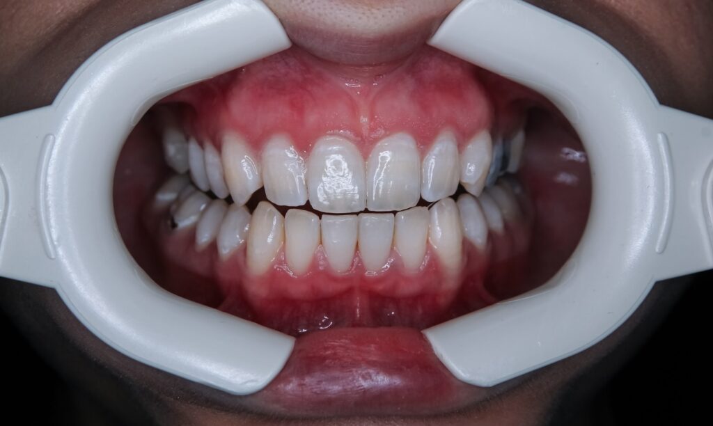 Orthodontie adulte à Bulle : pourquoi se lancer après 30 ans ? a person's mouth with teeth