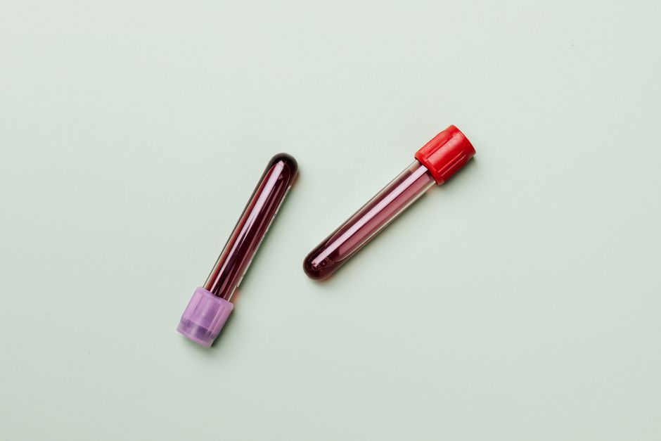 Les œufs augmentent-ils vraiment le cholestérol? On a vérifié Blood samples in test tubes on a light background, ideal for medical and laboratory themes.