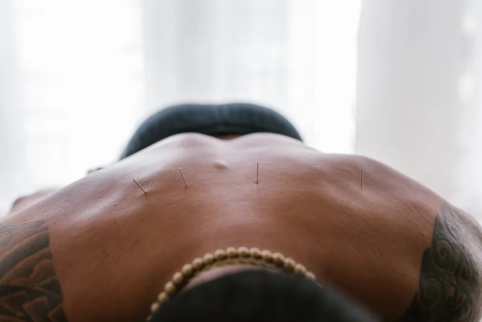 Close-up image of acupuncture needles applied to a person's back during treatment.