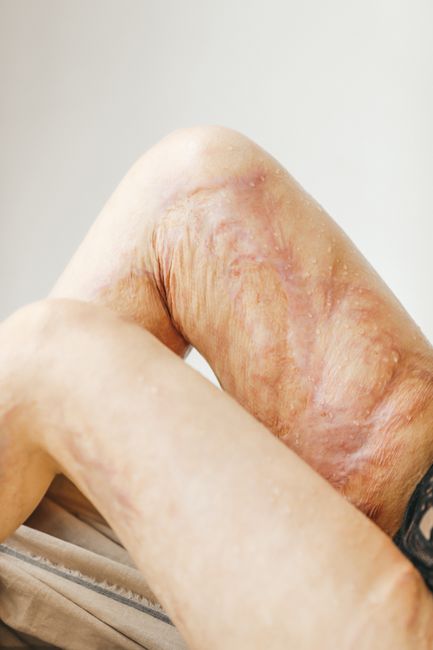 Detailed close-up of burn scars on a woman's legs, highlighting skin texture and healing.